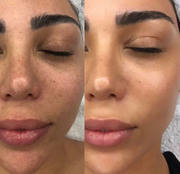 Nolenna™ Maschera al Bio-Collagene