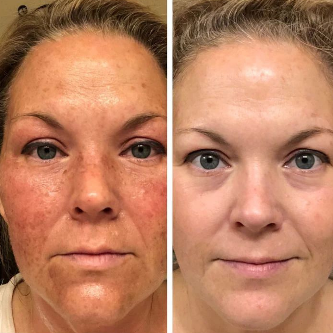Nolenna™ Maschera al Bio-Collagene